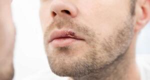 Candida Mantarının Belirtileri